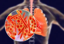 Pneumonia not caused by cold – Physician